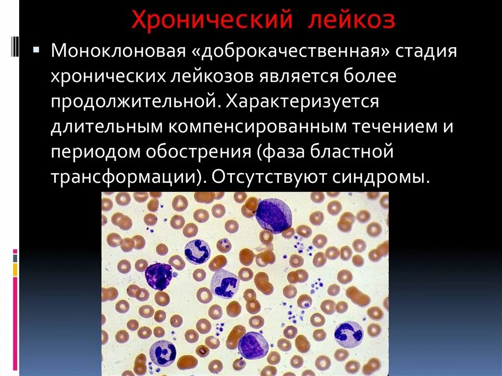 Хронический лейкоз. Моноклоновая стадия лейкоза. Хронический гемобластоз. Хронический мегакариоцитарный лейкоз.