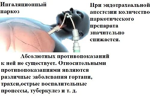Какой наркоз при катаракте. Эндотрахеальное обезболивание. ингаляционный наркоз эндотрахеальный. интубационная анестезия.