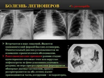 Болезнь легионеров