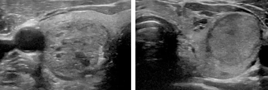 Ti rads 4. Tirads 4 щитовидная железа. Тирадс 3 щитовидной железы на УЗИ. Узловое образование ti-rads4. Ti rads 3 в щитовидной