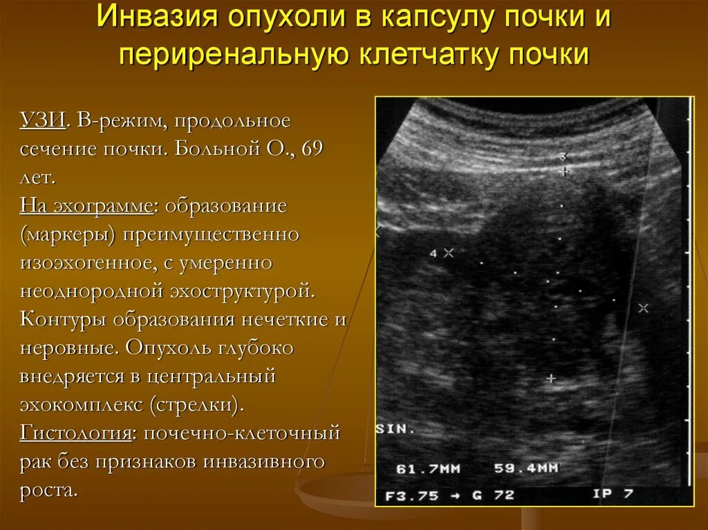 Очаговые изменения почки. Объемное образование в почке на УЗИ что это. Новообразования почки на УЗИ.