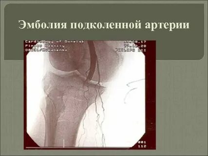 Воздушная эмболия