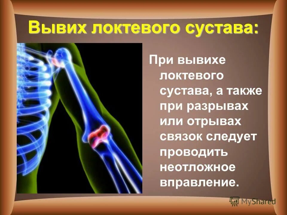 При вывихе суставов следует. При вывихе локтевого сустава. пмп при вывихе локтевого сустава. вывих локтевого сустава пмп.