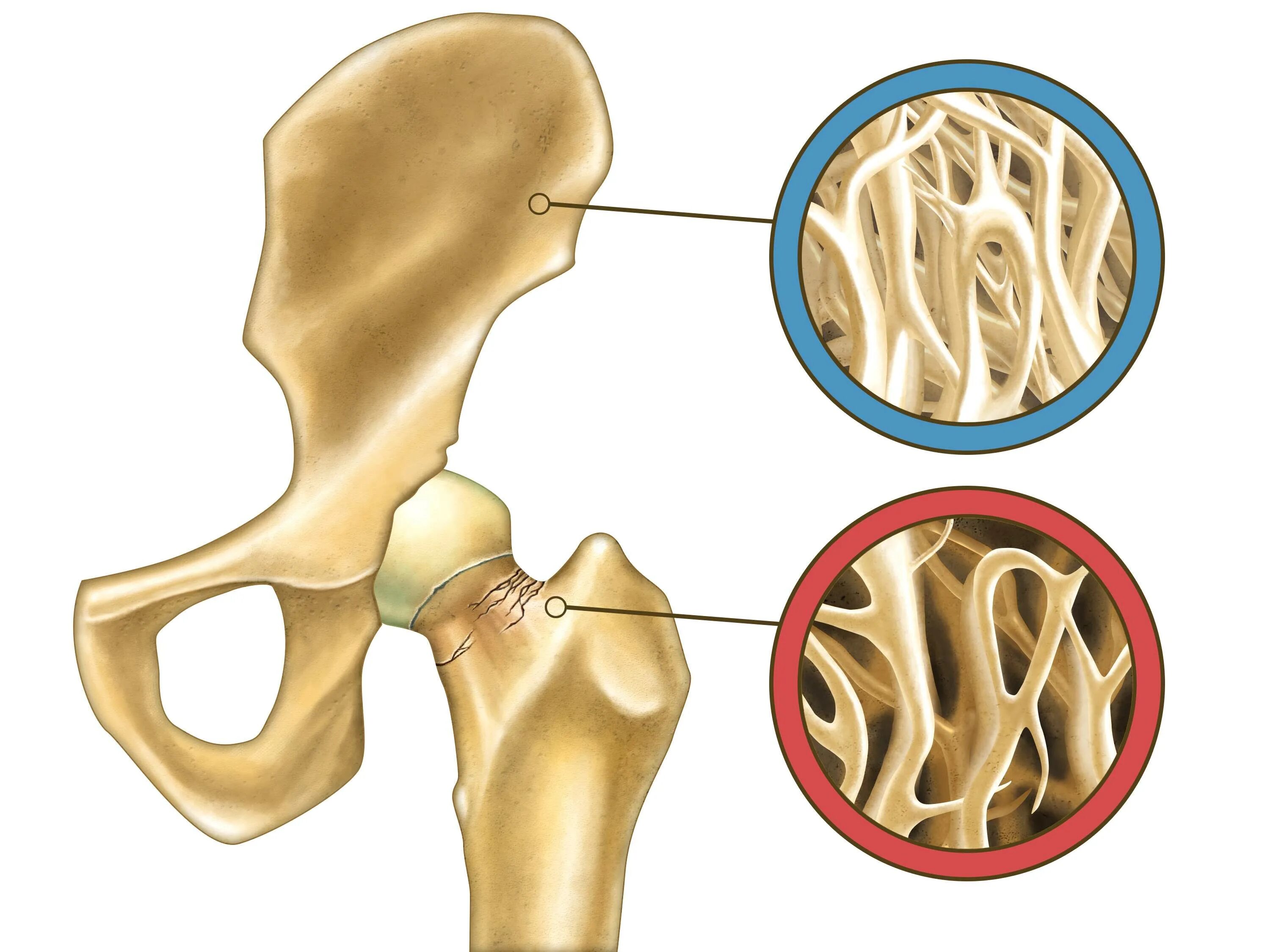 Лечение костных заболеваний. Остеопороз кости. Osteoporosis Bone. Остеопороз вымывание кальция.