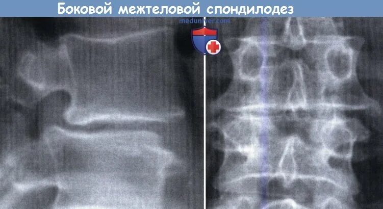 Спондилодез поясничного отдела позвоночника рентген. Замыкательных пластин рентген. Замыкательные пластинки на рентгене. Межтеловой спондилодез поясничного отдела позвоночника.