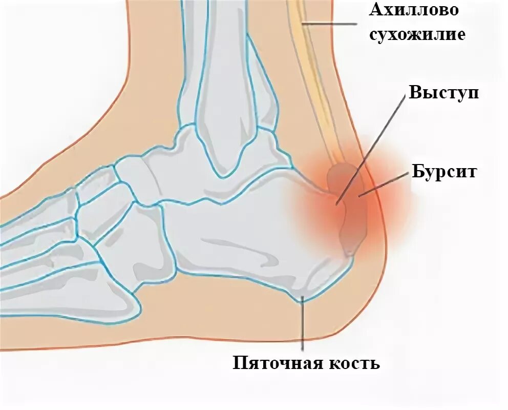 Синовиальные сумки голеностопного сустава. Синовит голеностопа сустава. Синовиальная оболочка голеностопного сустава анатомия. Суставная сумка голеностопа. Бурсит большого стопы