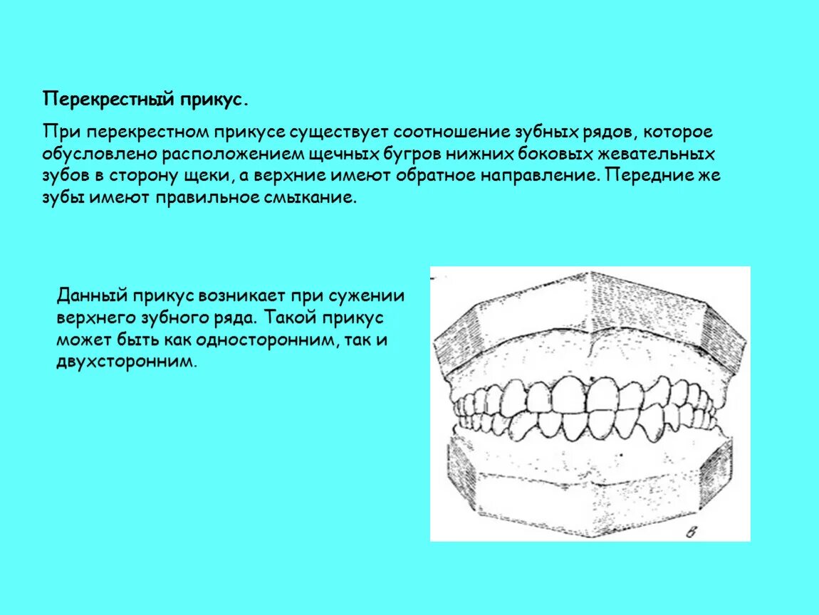 Подвижное соединение челюстей. Трансверзальные аномалии прикуса перекрестный прикус. LM активатор перекрестный прикус. Перекрестный прикус фронтальные зубы. Перекрестный прикус верхней челюсти.