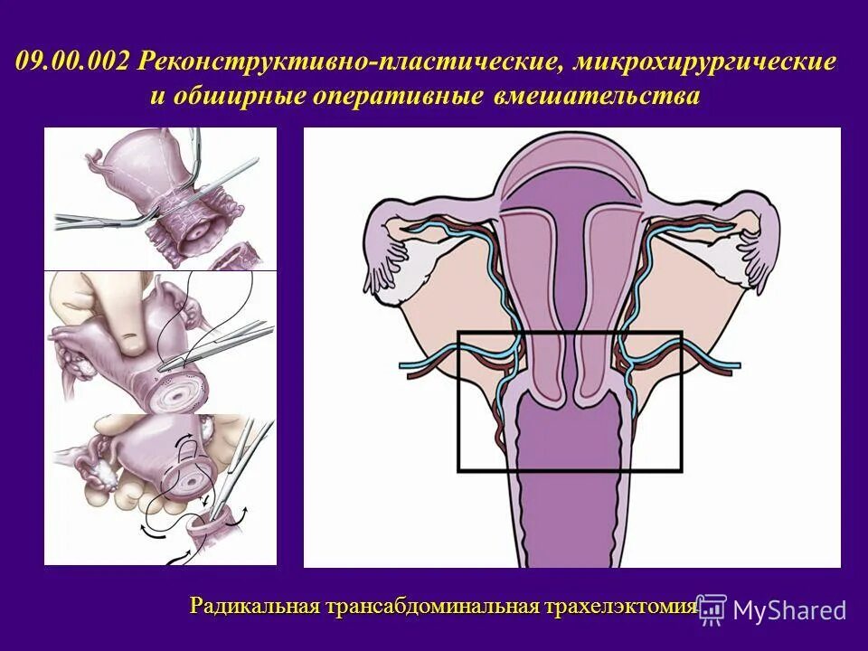 Влагалищная экстирпация матки этапы операции. Трахелэктомия шейки матки. Экстирпация культи шейки матки. Радикальная трахелэктомия шейки матки.