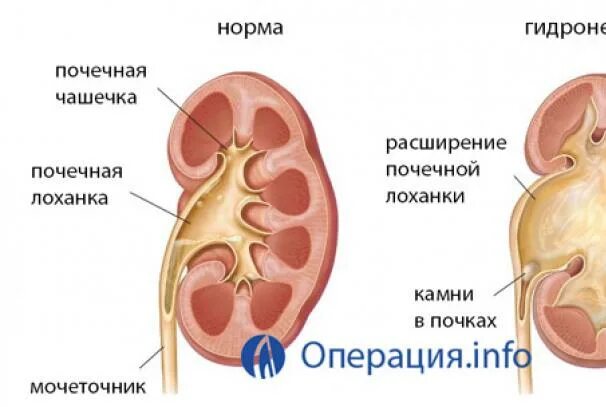 Врожденный гидронефроз (водянка почки). Операция при гидронефрозе почки. Расширение чашечек почки. Гидрокаликоз почек. Почему лоханка