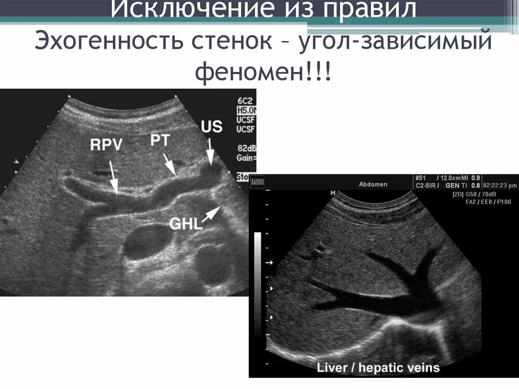 Эхогенность структуры при УЗИ. Виды эхогенности. Типы эхоструктуры. Понятие естественная эхогенность. Что означает эхогенность печени