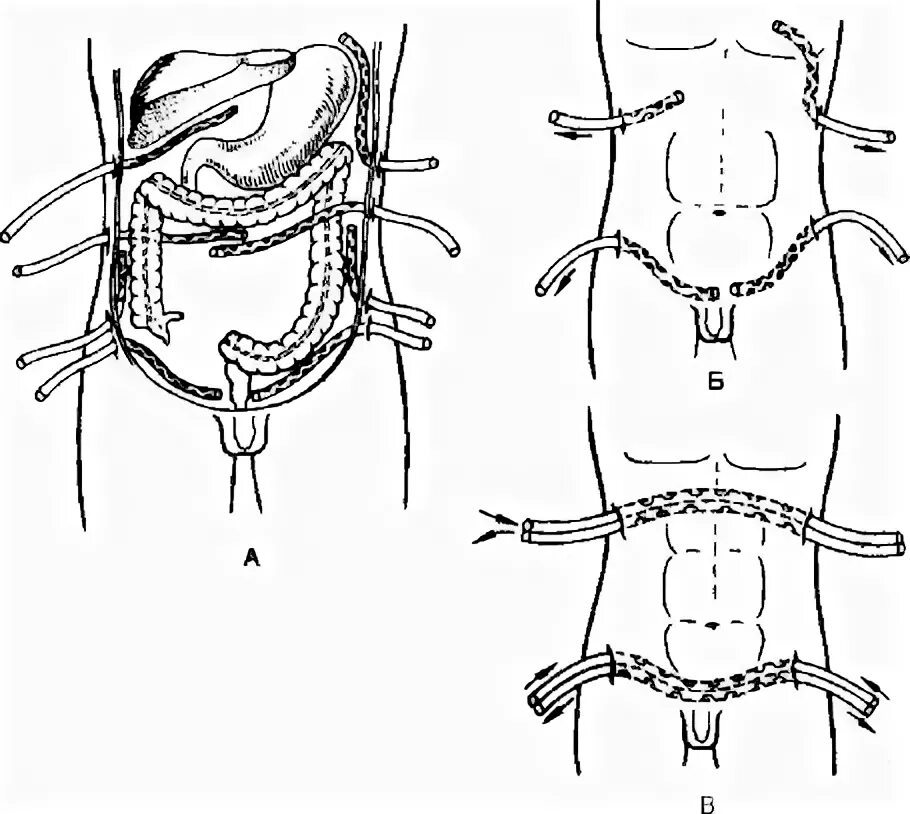 дренаж операции на брюшной. дренирование брюшной полости санация брюшной полости. послеоперационный дренаж брюшной полости. методы дренирования брюшной полости при перитоните. дренирование брюшной полости.