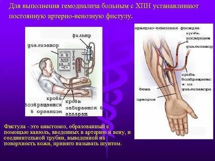 Фистула что это