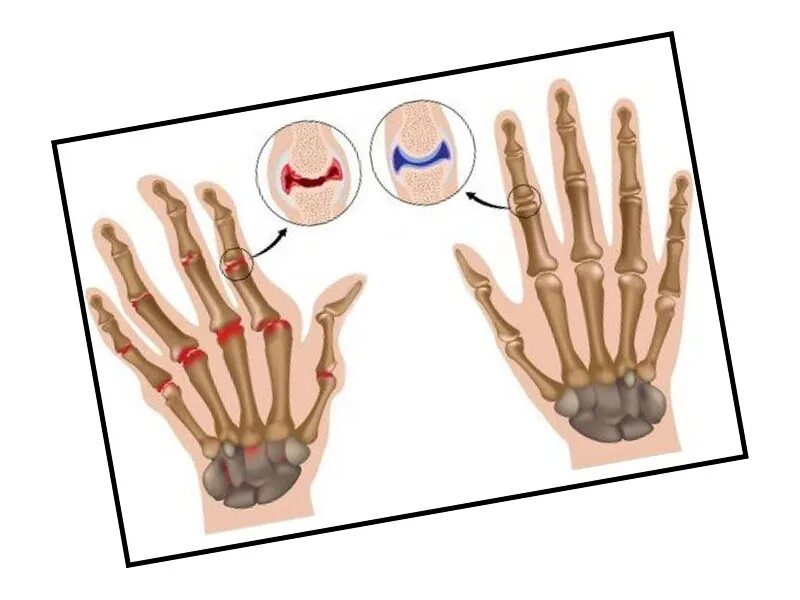 полиостеоартроз гебердена. остеоартроз пальцев кисти. остеоартроз пальцев кисти. ревматоидный артрит лучезапястного сустава. деформирующий остеоартроз суставов кисти.