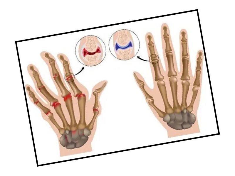 Артрит межфаланговых. Полиостеоартроз суставов кистей рук. Артроз в дистальных межфаланговых. Ревматоидный артрит пястно фаланговый.
