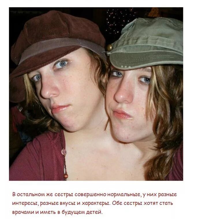 Близнецы хенсел вышли замуж. Близнецы хенсел вышли замуж