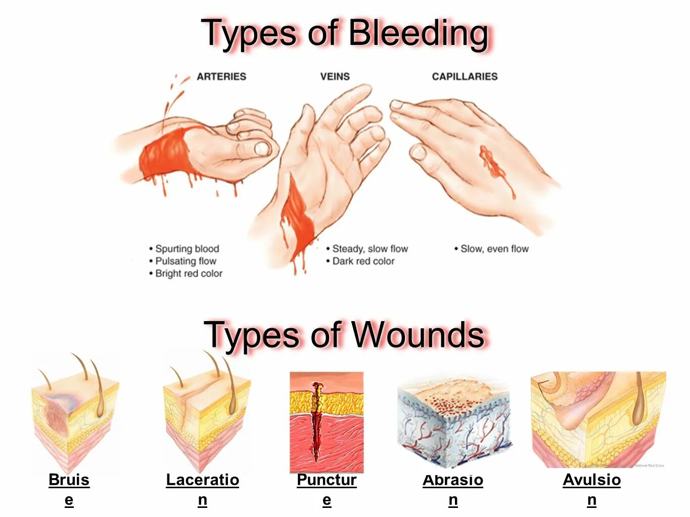 Types of wound
