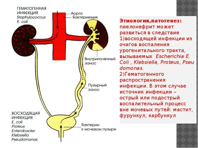 Кровь в лоханке почки. Гематогенный путь проникновения инфекции в почки. Хронический пиелонефрит гематогенный путь. Патогенез острого пиелонефрита схема. Патогенез развития хронического пиелонефрита.