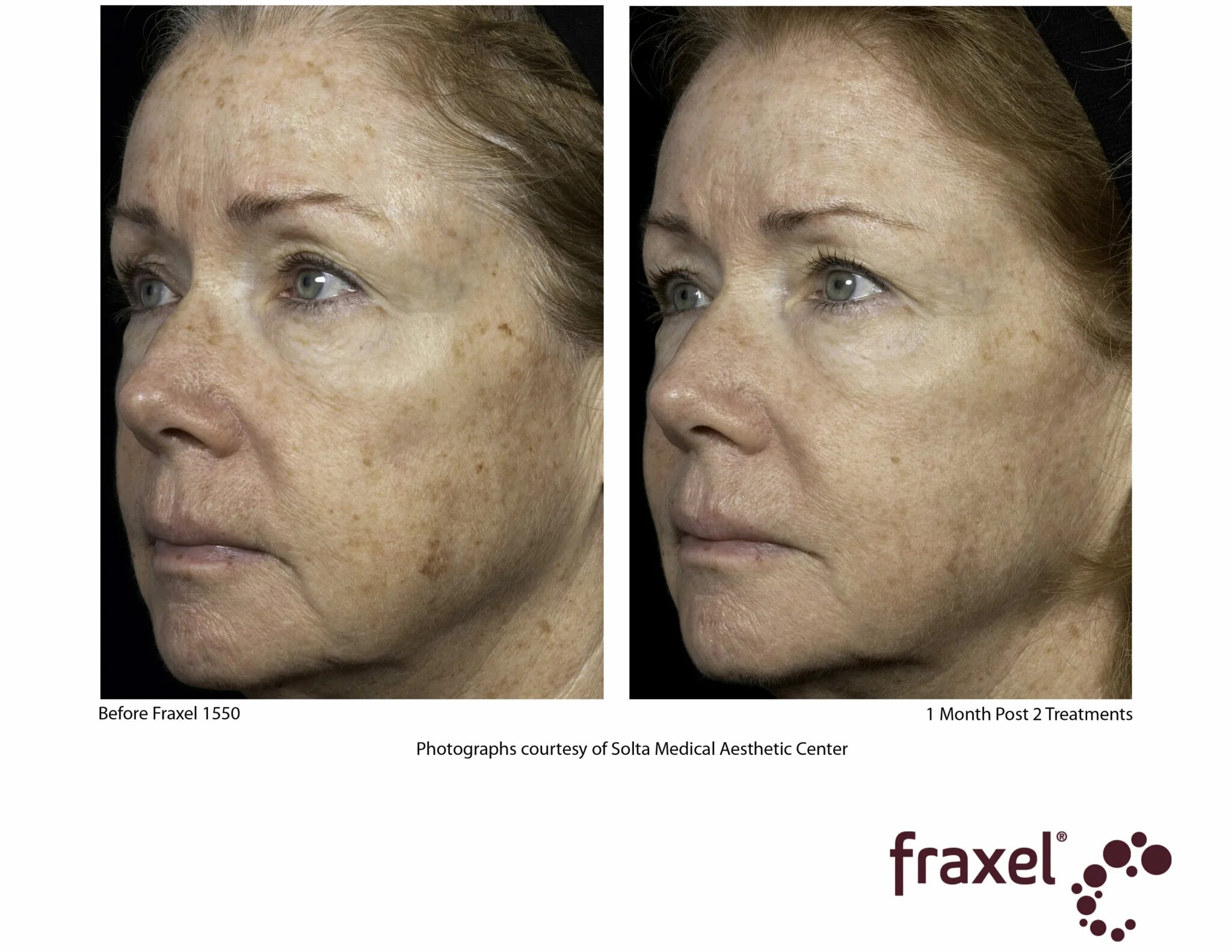 какой крем после лазерной шлифовки