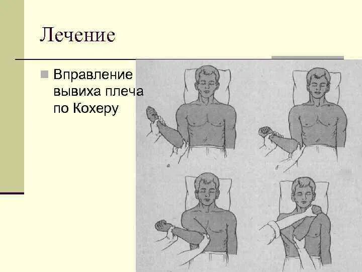 Как лечить вывих. Вправление вывиха плеча (методом кохера).. метод кохера вправление плеча. метод кохера вправление. вправление вывиха плеча по кохеру алгоритм.