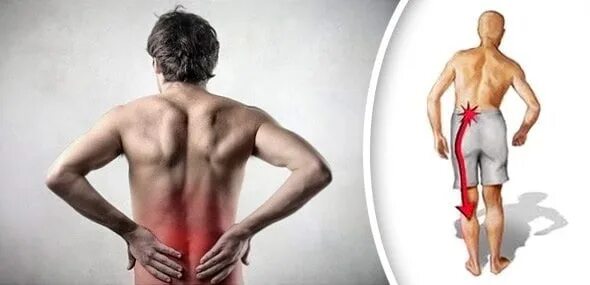 Иррадиация боли в ногу. Атрофия мышц спины фото. Атрофия мышц при остеохондрозе. Силуэт мужской спины остеохондроз.