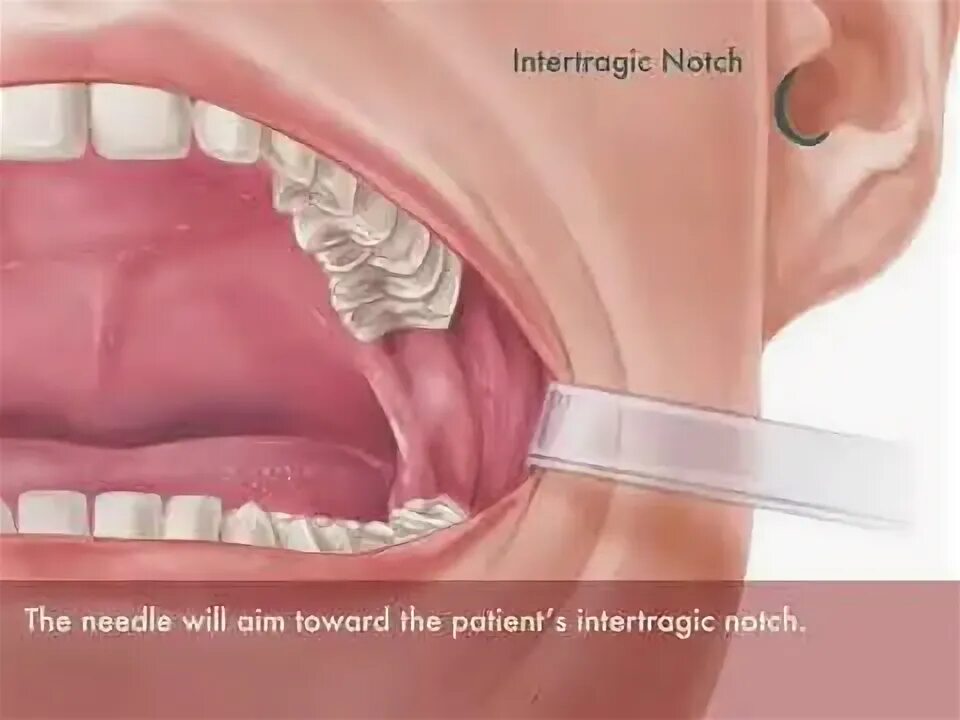 Обезболивание по гоу Гейтсу. Анестезия по гоу Гейтсу. Отличие мандибулярной от торцсальной. Гоу гейтс