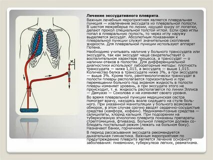 Основной метод лечения экссудативного плеврита