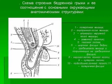 Тазобедренная грыжа