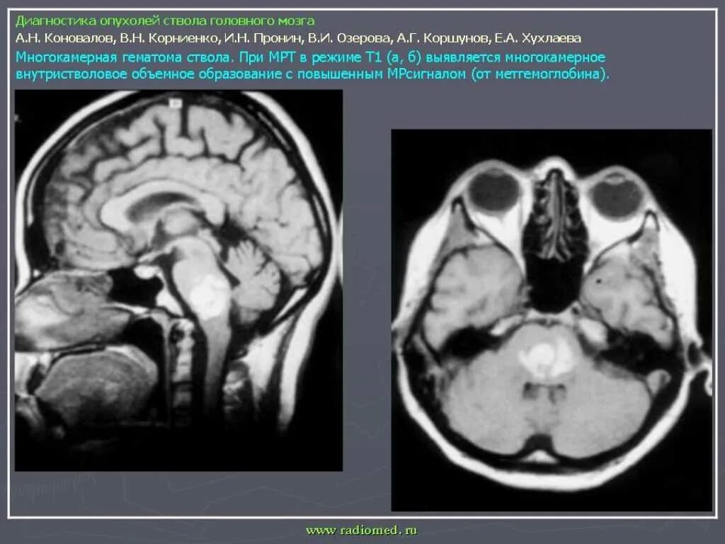 Рак ствола головного мозга. Опухоль ствола мозга на кт. Глиома ствола мозга мрт. Глиальная опухоль головного мозга кт. Неоперабельная глиома ствола головного.