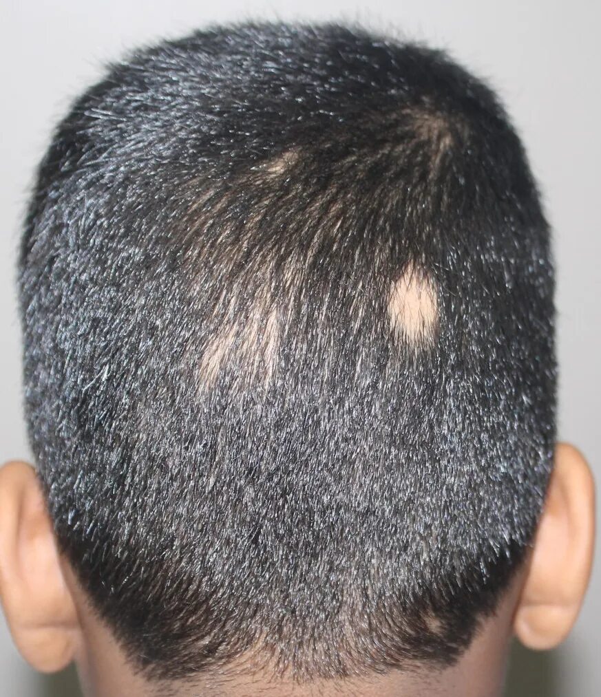 Очаговая (гнездная) алопеция. Очаговая (гнездная) алопеция. Очаговая (гнездная) алопеция. Нерубцовая гнездная алопеция. Облысение участками.