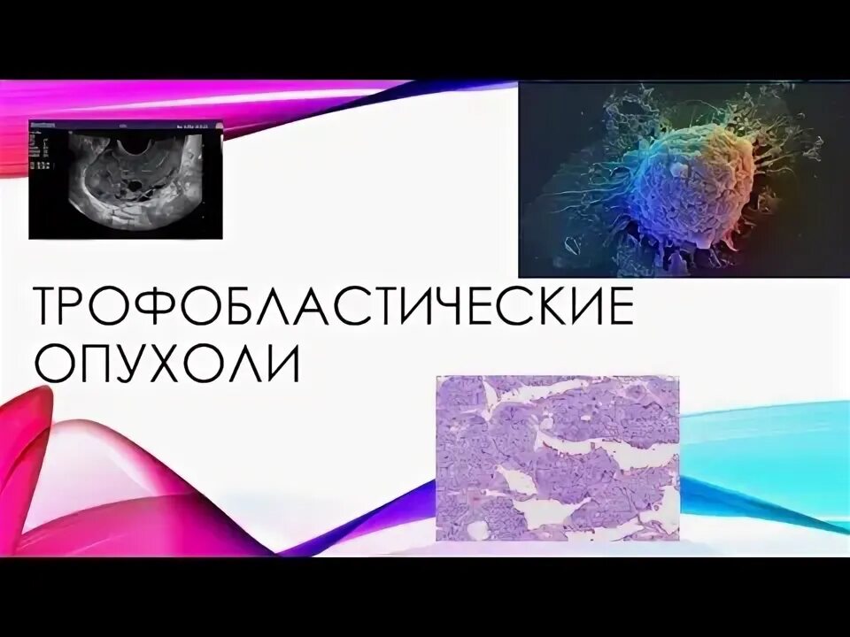 Трофобластическая опухоль. Трофобластическая опухоль. Трофобластические опухоли. Трофобластическая болезнь патогенез. Трофобластическая болезнь патогенез.