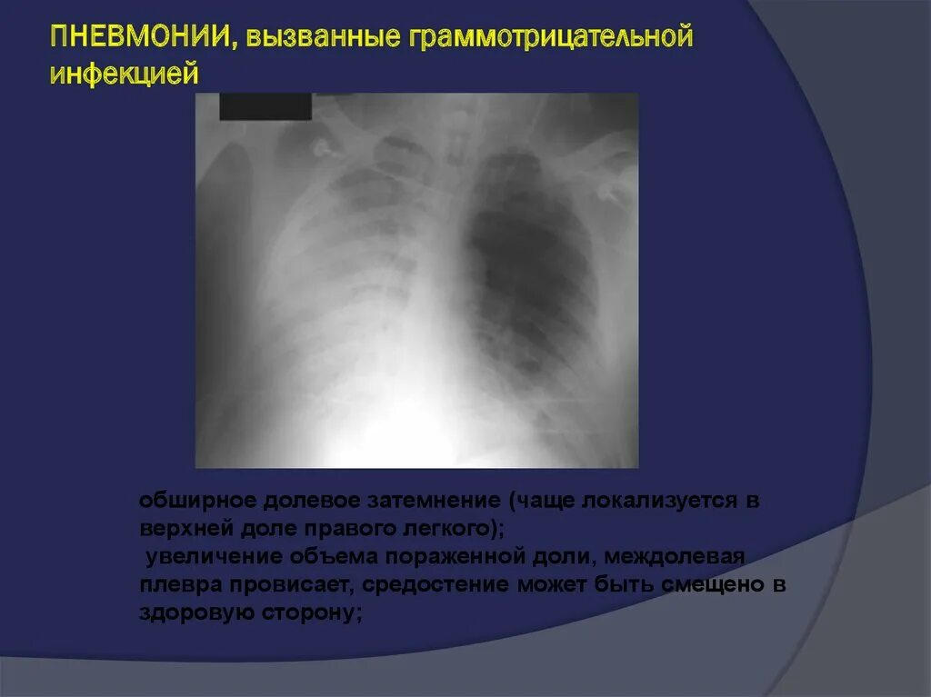 Лучевые заболевания легких. Междолевая пневмония рентген. Междолевой плеврит рентгенограмма. Утолщение междолевой плевры на кт. Лучевая диагностика легких презентация.