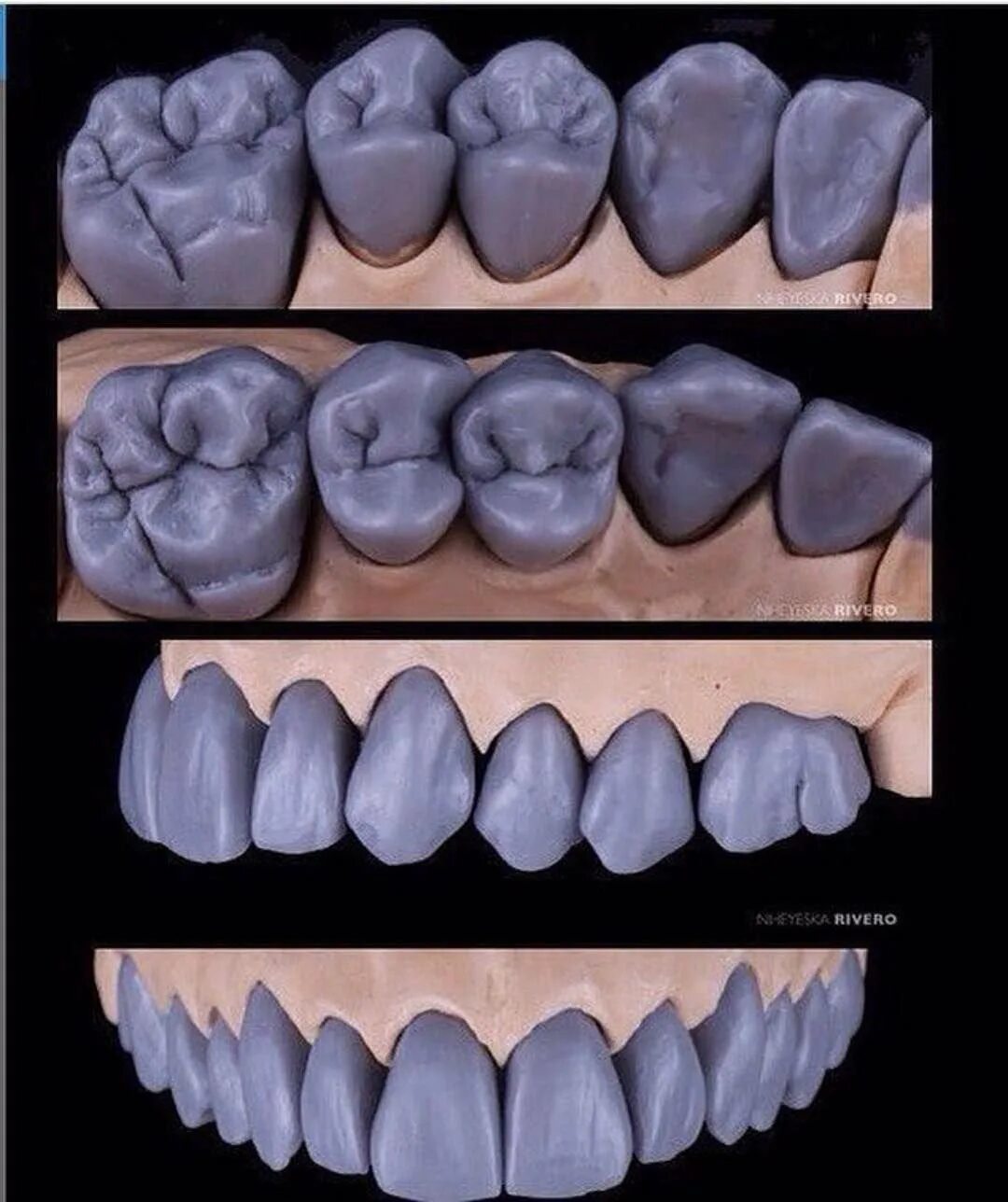 Типы реставраций. Моделировка клыка верхней челюсти из воска. Моделировка 2 моляра нижней челюсти. Зубы нижней челюсти моделировка. Моделировка жевательных зубов нижней челюсти.