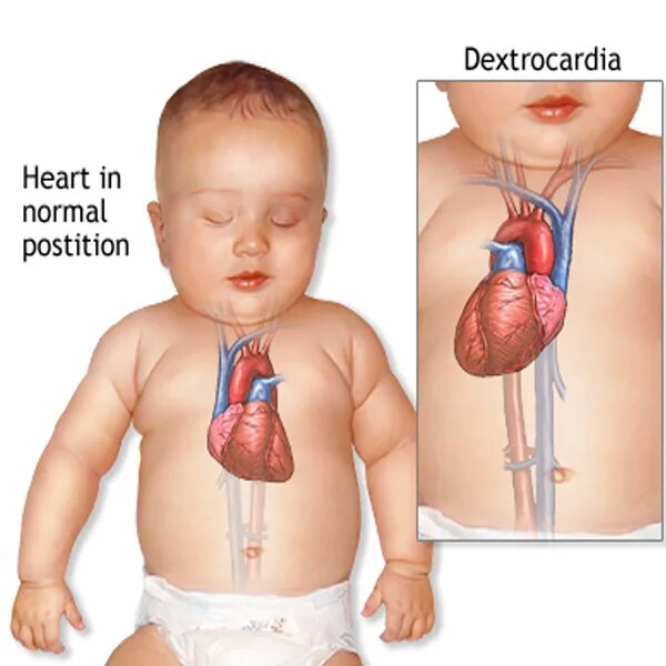 Врожденная декстрокардия. Декстропозиция сердца. Аномальное расположение сердца. Декстрокардия рентген картина. Декстрокардия синдром.