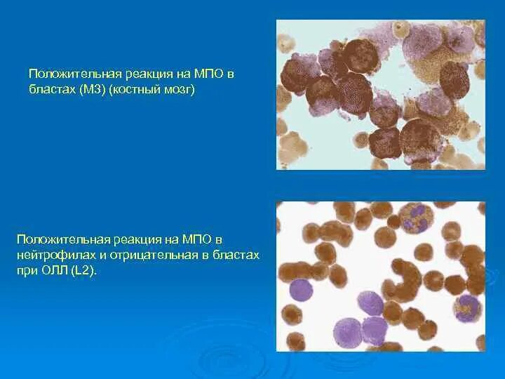 Что означает положительная реакция. Цитохимия миелопероксидаза. Миелопероксидаза при лейкозах положительная. Лимфобластный лейкоз реакция на миелопероксидазу. Реакция на миелопероксидазу.