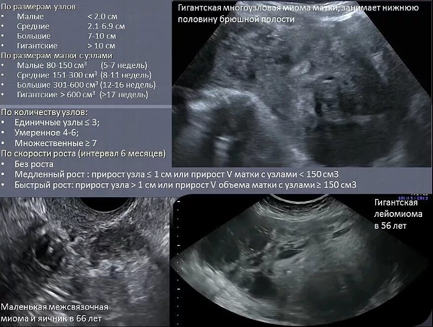 Диаметры узлов миомы матки. Миома больших размеров на УЗИ.