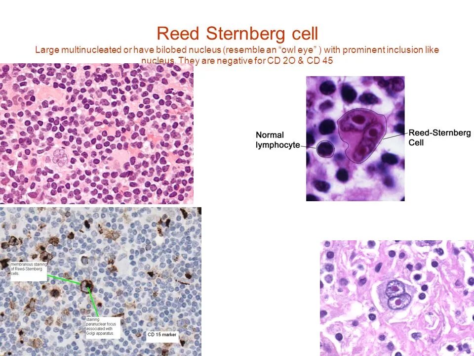 Рид штернберга. Рид Штернберга клетки гистология. Клетки Рид-Березовского-Штернберга. Клетки Рида Березовского Штернберга.
