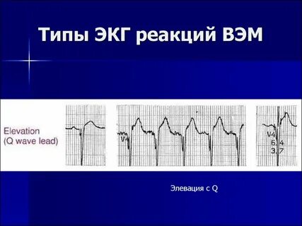 Виды экг