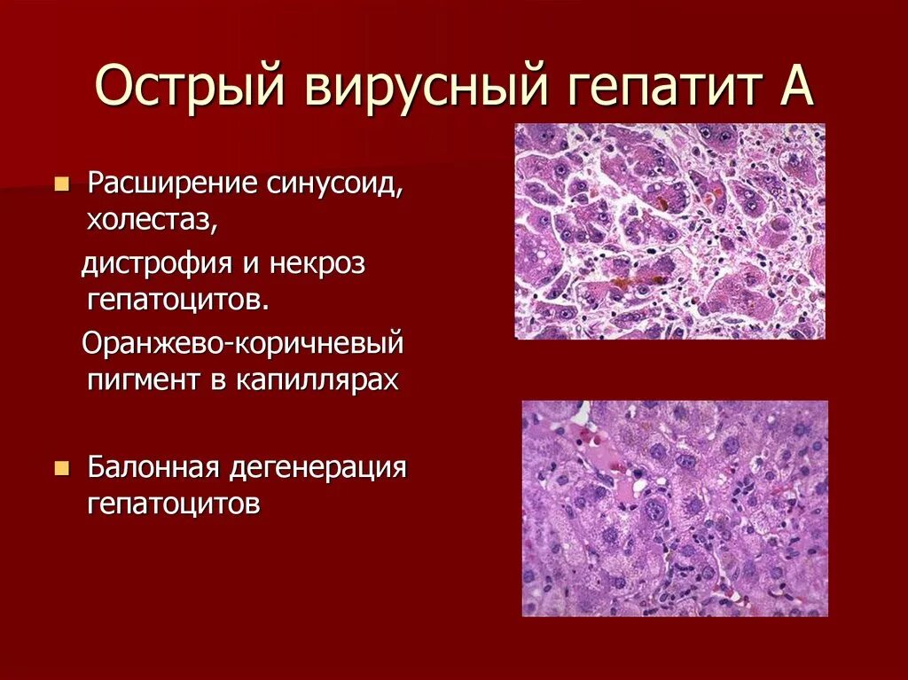 Вирусный гепатит макропрепарат патанатомия. Вирусный гепатит острая циклическая форма микропрепарат. Вирусный гепатит микропрепарат. Вирусный гепатит б патанатомия.