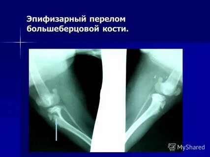 Внутрисуставной перелом