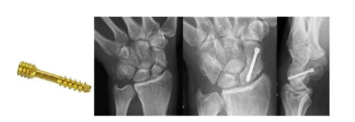 Перелом ладьевидной кости симптомы. Перелом ладьевидной кости лучезапястного сустава. Ладьевидная кость запястье перелом. Ладьевидная кость кисти перелом. Лечение переломов костей запястья.