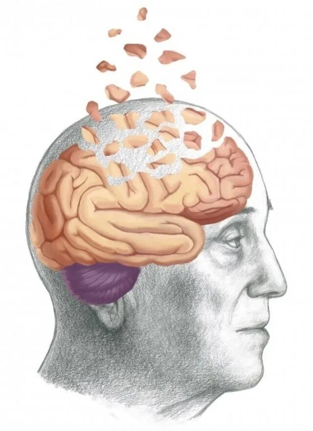 Болезнь Альцгеймера деменция. Старение мозга. Мозг стареет. Brain disease