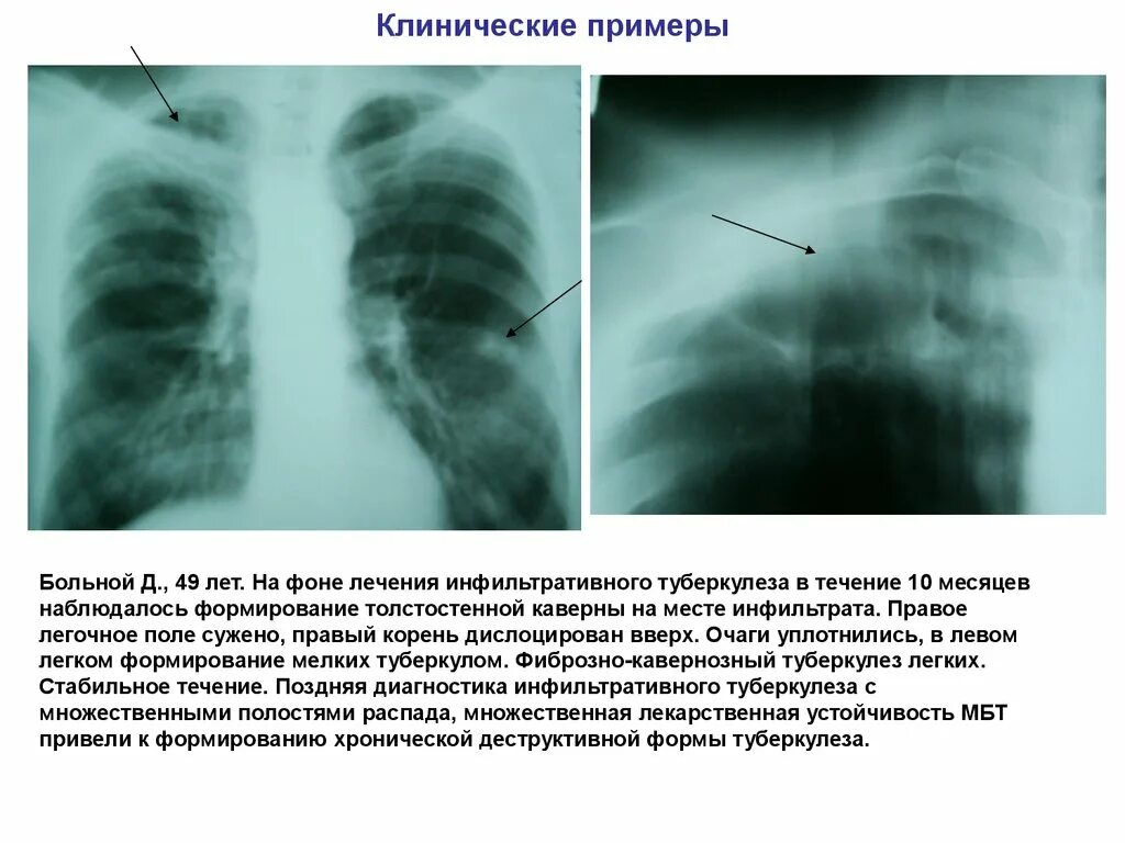 Лечение инфильтративного туберкулеза. Инфильтративный туберкулез клинические формы. Инфильтративный туберкулез правого легкого в фазе инфильтрации. Инфильтративный туберкулез с распадом рентген.