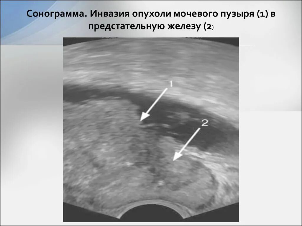 Сонограмма мочевого пузыря. Перивезикальная клетчатка мочевого пузыря. Онкология мочевого пузыря на УЗИ. Карцинома мочевого пузыря т1.