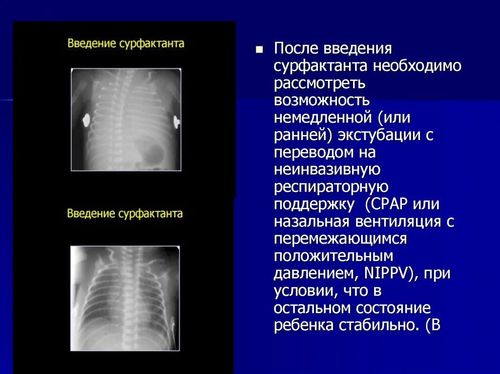 Респираторный дистресс новорожденных. Респираторные нарушения у новорожденных. Синдром дыхательных расстройств у новорожденных. Респираторный дистресс-синдром у новорожденных. Респираторный дистресс синдром новорожденных рентген.