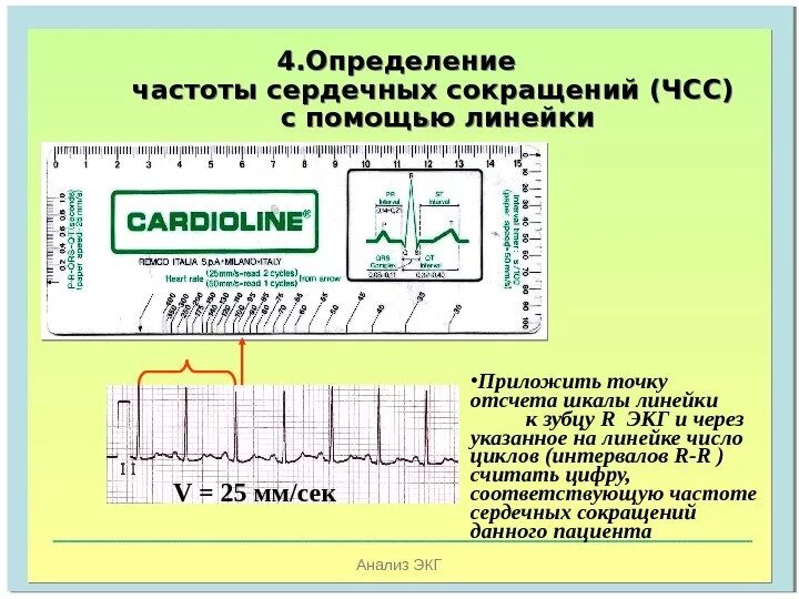 Как измерить частоту сердечных. Подсчет ЧСС на ЭКГ 25 мм/с. Формула расчета ЧСС по ЭКГ. ЧСС по ЭКГ 50 мм/с. Подсчет ЧСС на ЭКГ 50 мм/с.