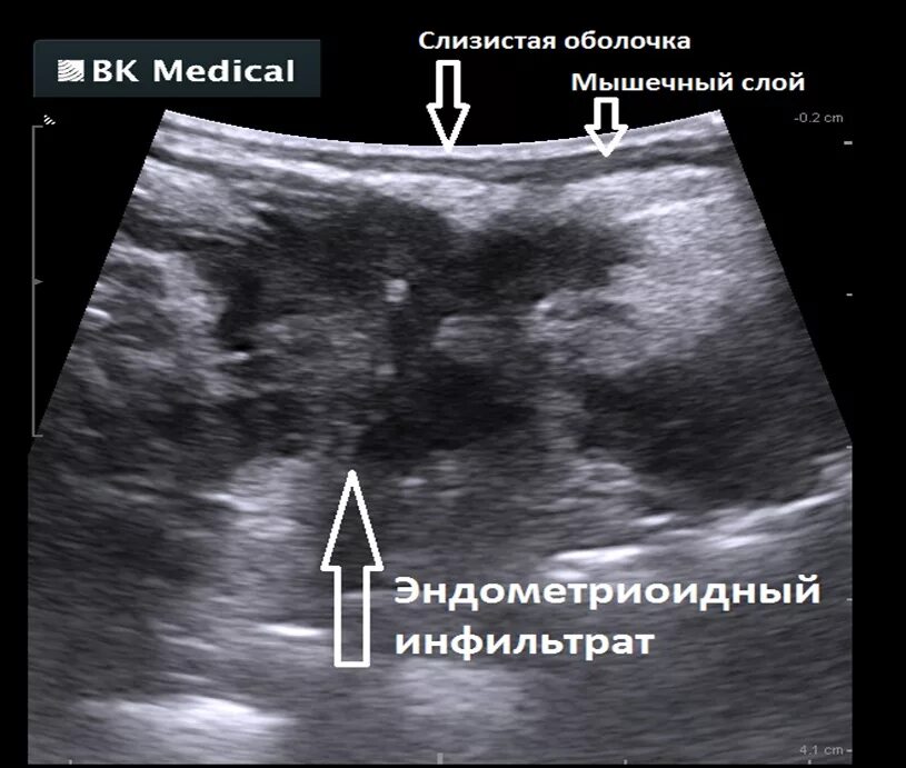 Эндометриоидный очаг на УЗИ. Эндометриоз шейки матки на УЗИ.