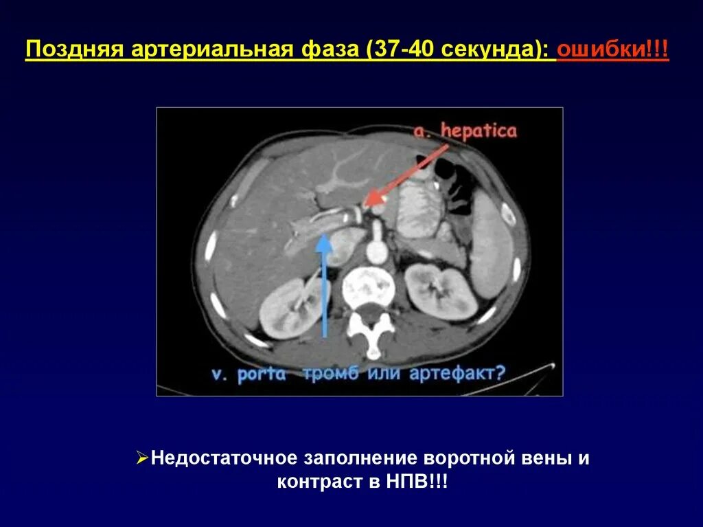 Тромбоз портальной вены кт. Тромб воротной вены кт. Тромб в воротной Вене на кт. Тромбоз вены печени