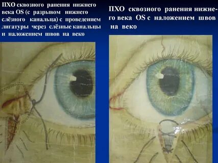 Сквозное повреждение