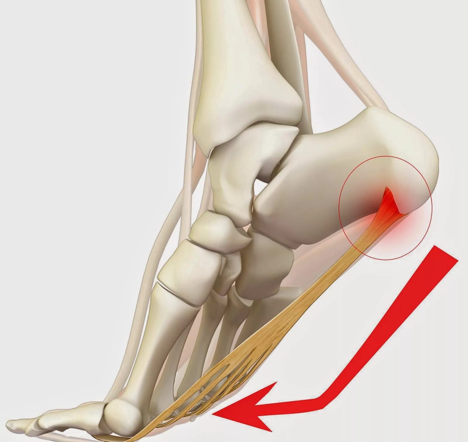 Подошвенный фасциит что это такое. Ахиллова пяточная шпора. Плантарный апоневроз стопы. Подошвенный (плантарный) фасциит.