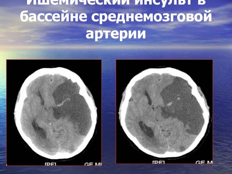 Левая средняя мозговая артерия инсульт. Ишемический инсульт в каротидном бассейне. Ишемический инсульт в бассейне левой СМА. Бассейн левой среднемозговой артерии. Ишемический инсульт в бассейне правой СМА.